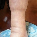 高齢者足の浮腫み