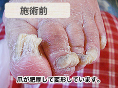 高齢者肥厚爪　施術前