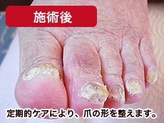 高齢者肥厚爪　施術後