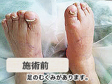 高齢者足の浮腫み　施術前