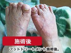 高齢者　足の浮腫み　施術後