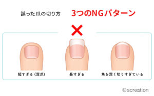 湘南あしケア訪問サービス　巻き爪になりやすい３つの爪切りNGパターン